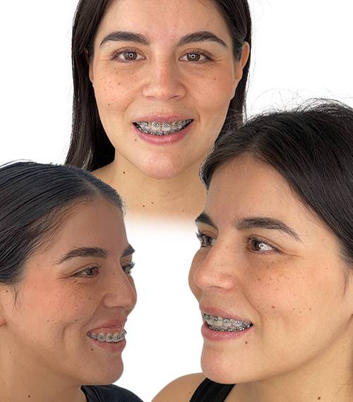Sonrisa Gingival