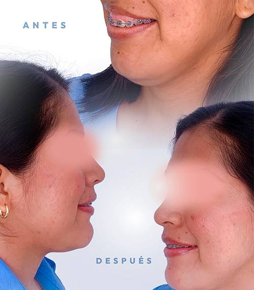 Sonrisa Gingival