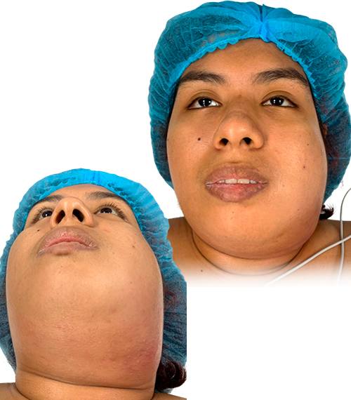 Tumor de Cuello