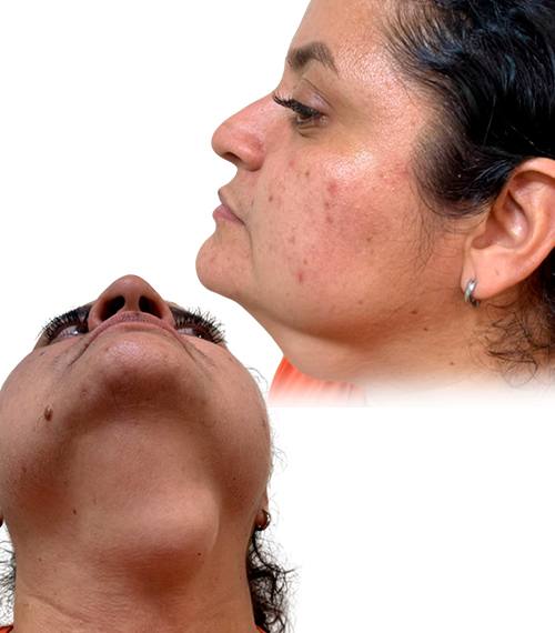 Tumor de Cuello
