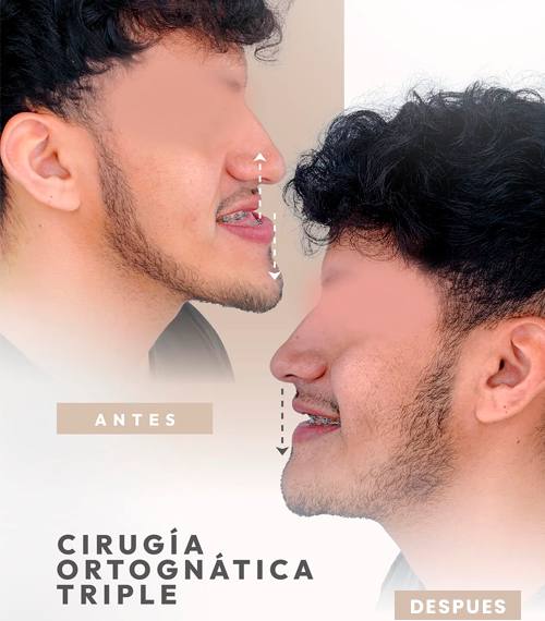 Cirugía Ortognática Triple
