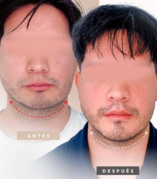 Desviación Mandibular
